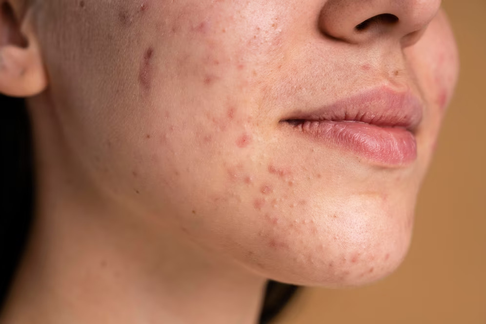 Rosacea