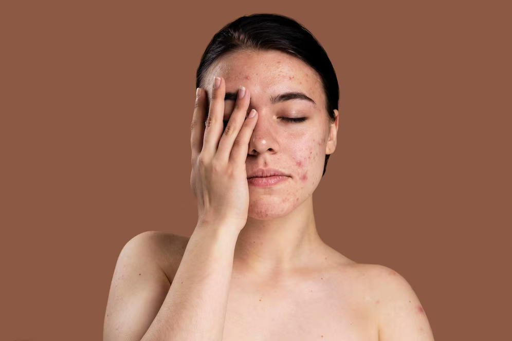 El peeling para tratar las cicatrices del acné