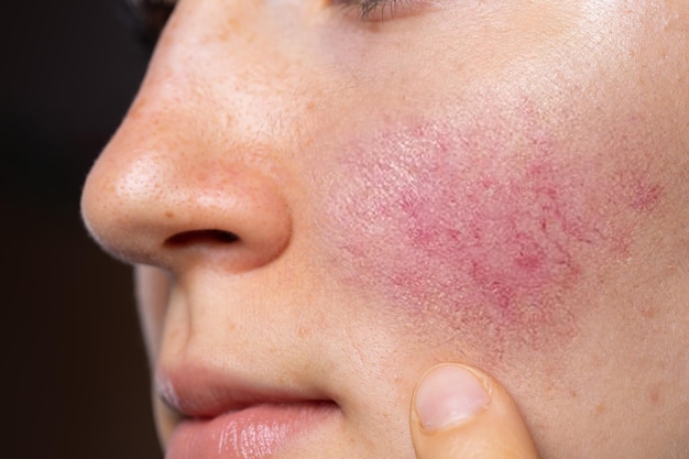 Treatment of Spots and Rosacea
