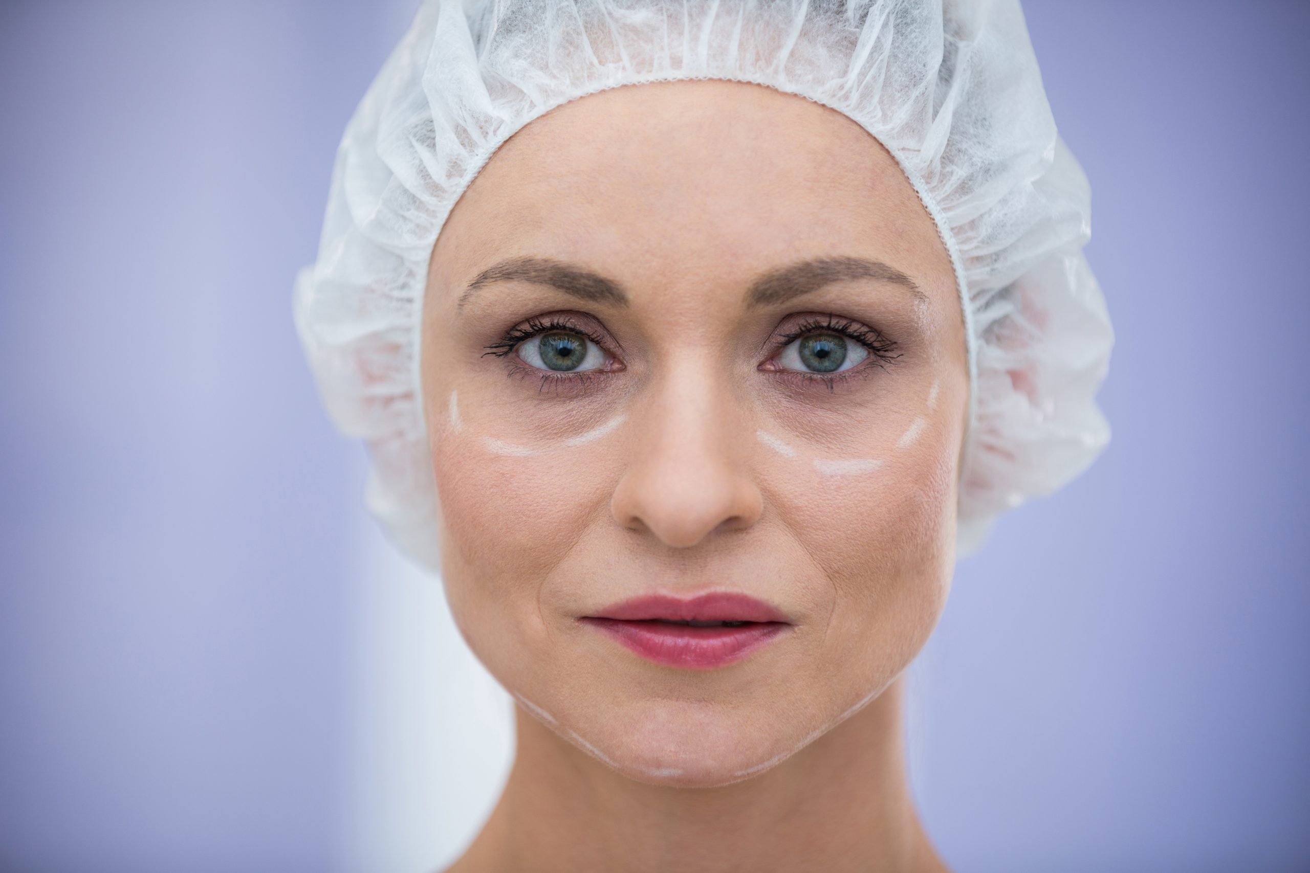 ¿Qué es y en qué consiste una blefaroplastia química?