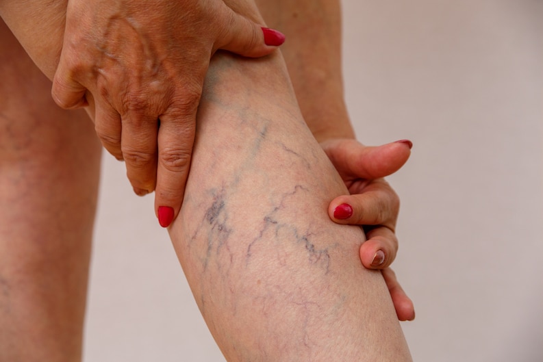 treatment for telangiectasias