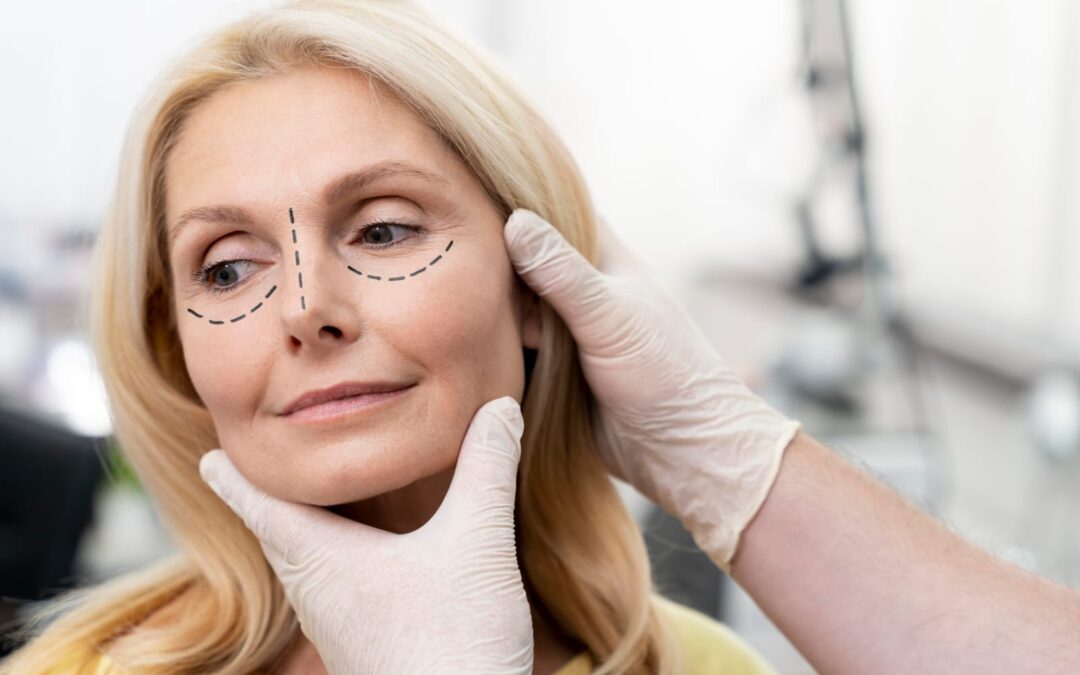 blefaroplastia quimica
