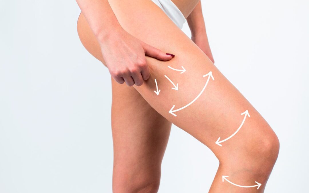 Combate la flacidez con el revolucionario tratamiento de Endopeel Corporal