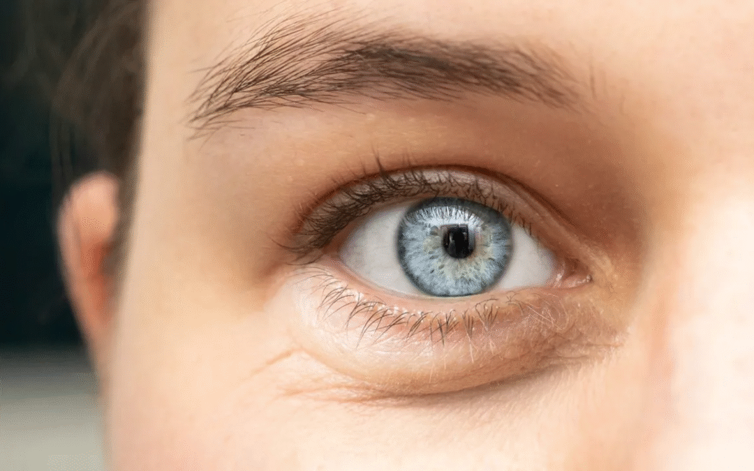 blefaroplastia laser