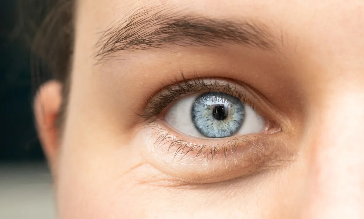 blefaroplastia laser