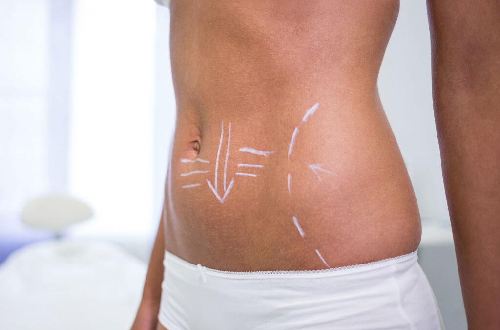 Laser lipolysis is a procedure that uses laser energy to break down fat cells, and it is used for body contouring and reducing localized fat deposits.