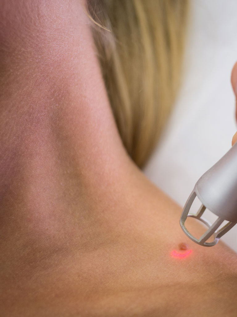 eliminacion de verrrugas con laser