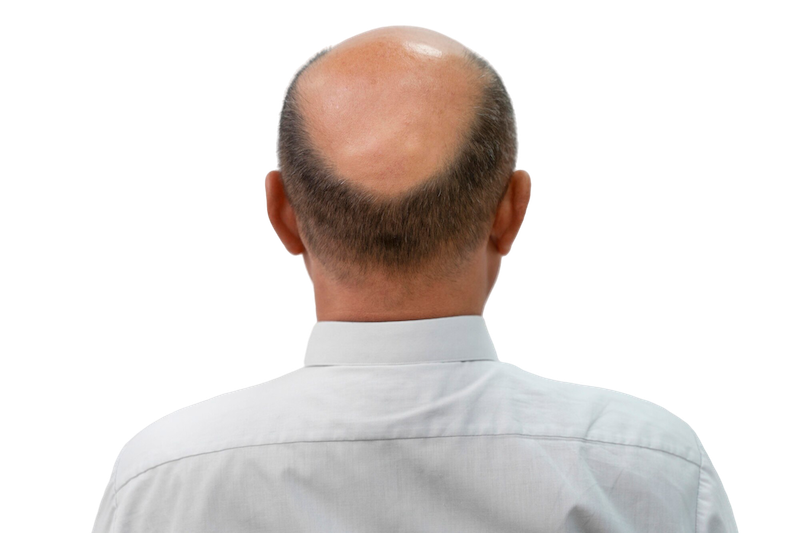 tratamiento para alopecia