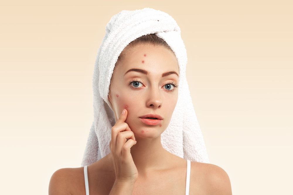 tratamiento para acne en bogota tratamiento para acne en bogota