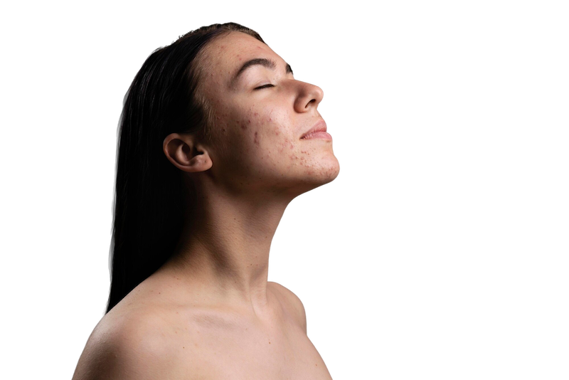 tratamiento para acne y cicatrices