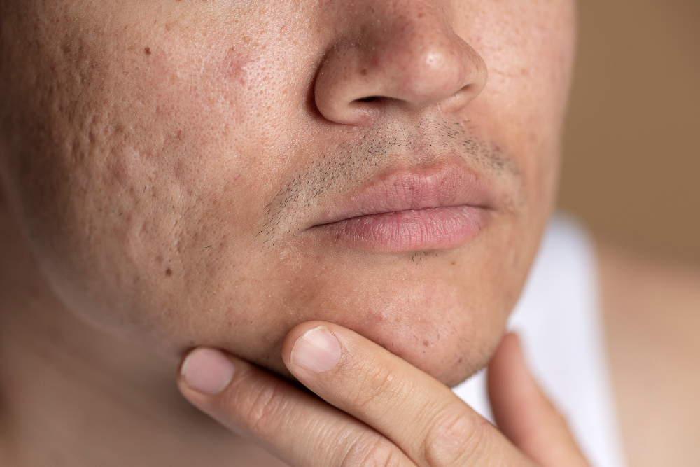 tratamiento para acne y cicatrices tratamiento para acne y cicatrices