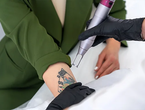 Eliminación de tatuajes en Bogotá Eliminación de tatuajes en Bogotá