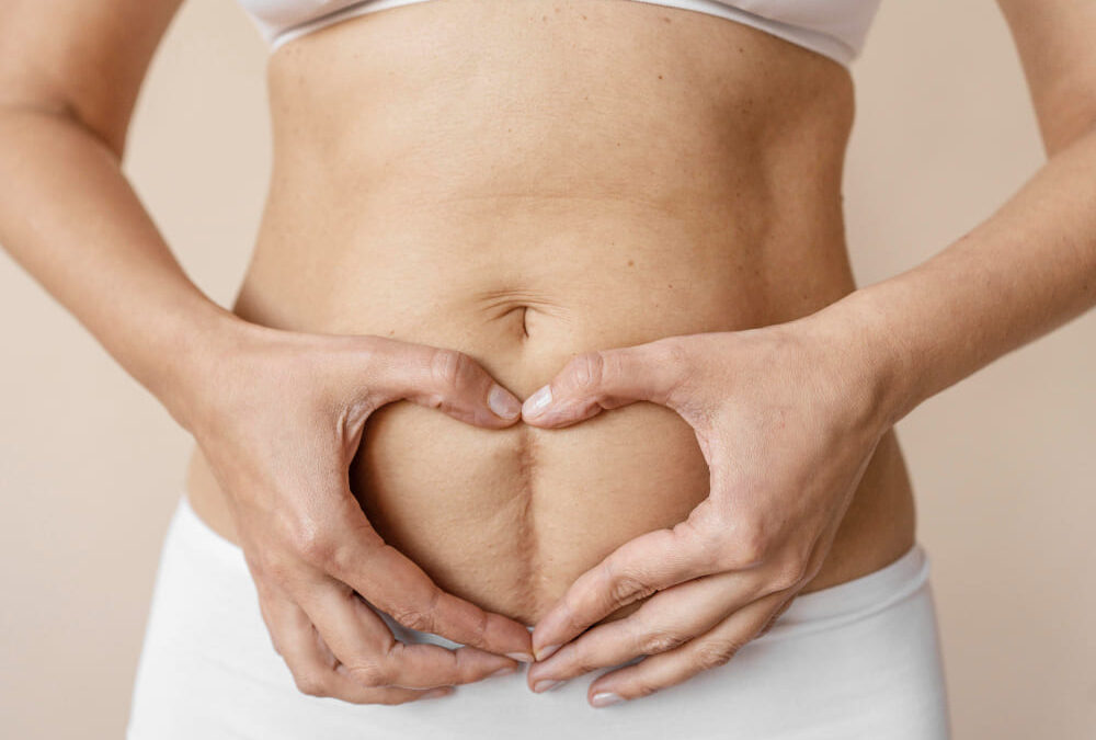Hilos Tensores en Abdomen Resultados